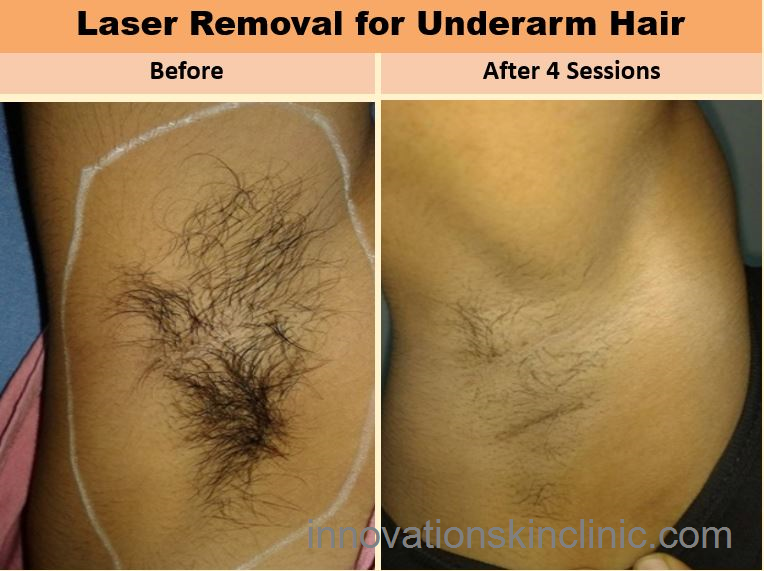 Laser Hair Removal 5